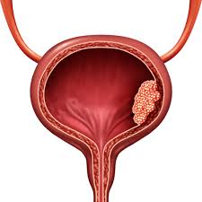 Bladder Cancer Market 2024-2032