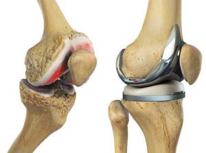 Knee Replacement Market 2024-2032