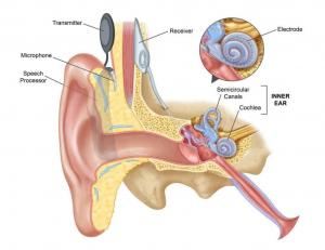 Cochlear Implants Market 2024-2032